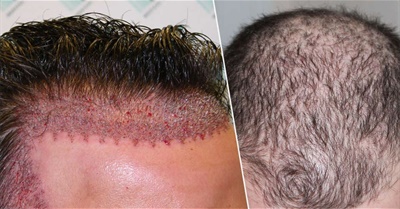 Hair Transplant Cost in Delhi