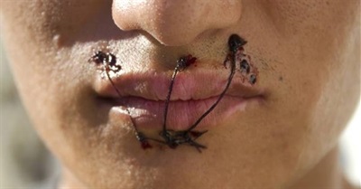 Shocking Conditions in Greek Detention Centres Lead to Detainees Sewing Their Mouths Shut