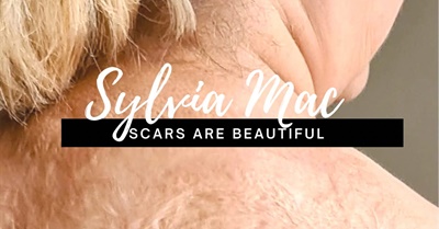 Free To Be Me, Finding Acceptance After Third Degree Burn Injury