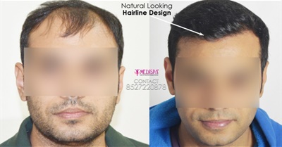 Does Hair Transplant Last Forever?